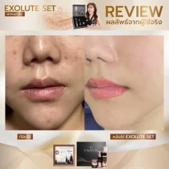 Reviwe EXOLUTE Set ชุดหน้าเด็ก ดูแลผิวหน้า เอ็กโซลูทเซ็ท